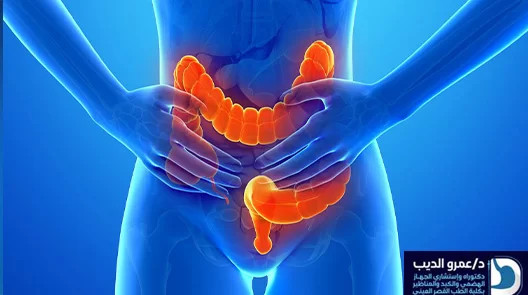 اعراض القولون العصبي